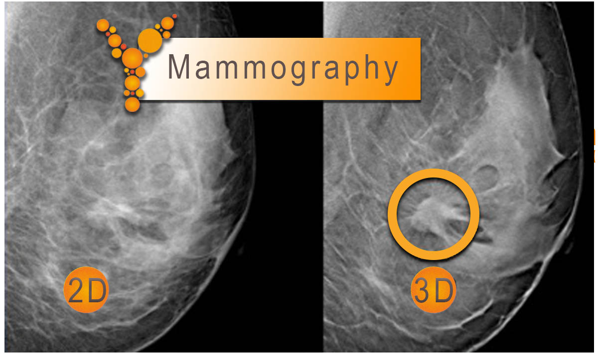 2d-vs-3d-mammography-emfanisi-karkinou